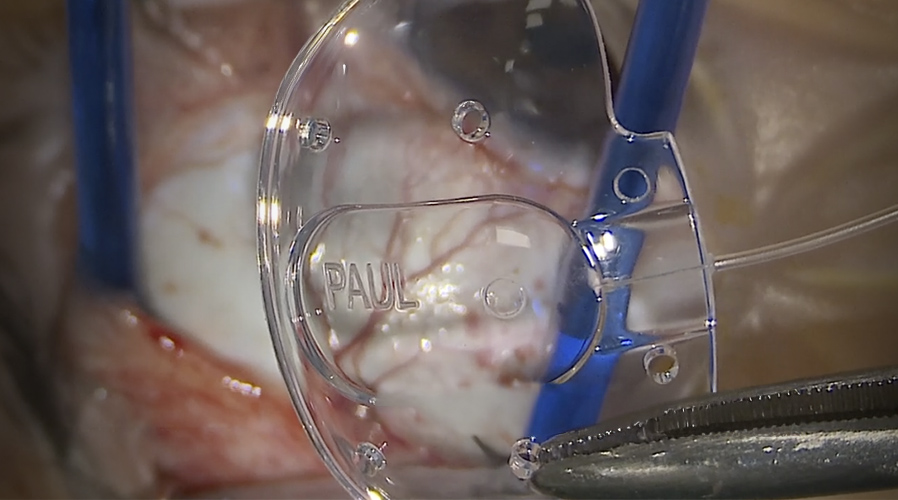 Paul Glaucoma Implant intraoperative drainage technique