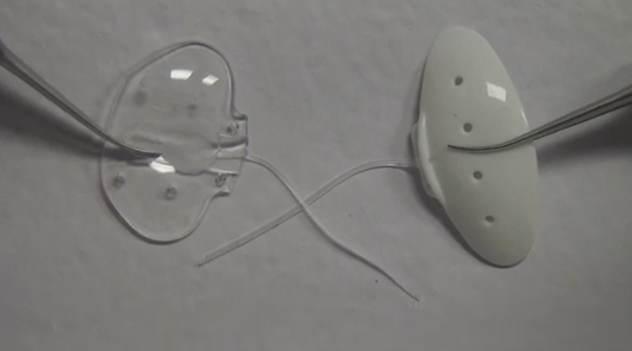 Paul Glaucoma Implant