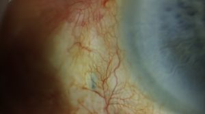 External cyclopexy ciliary body tear repair with scleral flap exposure and suprachoroidal access in chronic hypotony after Yamane IOL