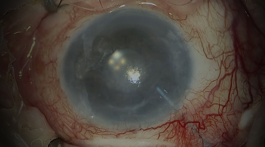 Baerveldt plate erosion revision surgery with implant removal and replacement using a Paul glaucoma implant