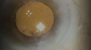 Carlevale IOL haptic erosion repair in recurrent exposure with scleral recession and patch graft