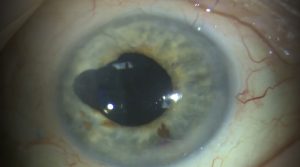 scleral fixation hypotony repair in Yamane IOL case