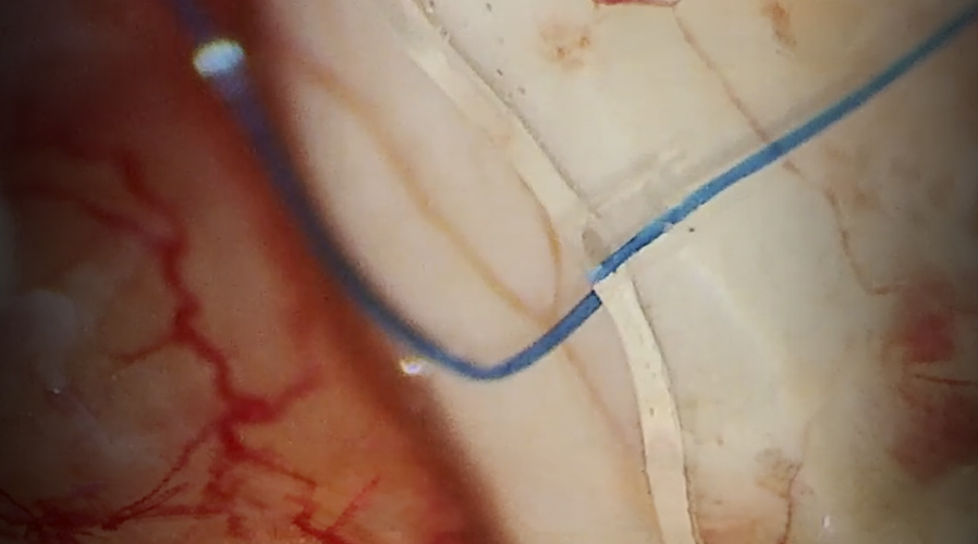 Intraoperative Paul glaucoma implant ligature adjustment demonstrating control of aqueous overdrainage and flow modulation