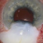 XEN bleb excision and Paul Glaucoma Implant insertion showing anterior segment surgery and conjunctival closure