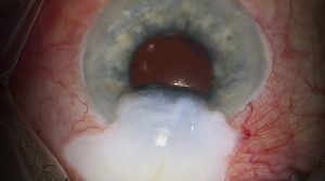 XEN bleb excision and Paul Glaucoma Implant insertion showing anterior segment surgery and conjunctival closure