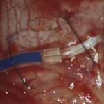 PRESERFLO MicroShunt revision surgery showing fibrosis removal, ripcord flow control, and tube implantation conversion