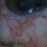 Trabeculectomy revision for hypotony maculopathy with pericardial patch and scleral flap repair